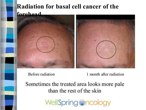 Radiation Treatment For Skin Cancer - All About Radiation