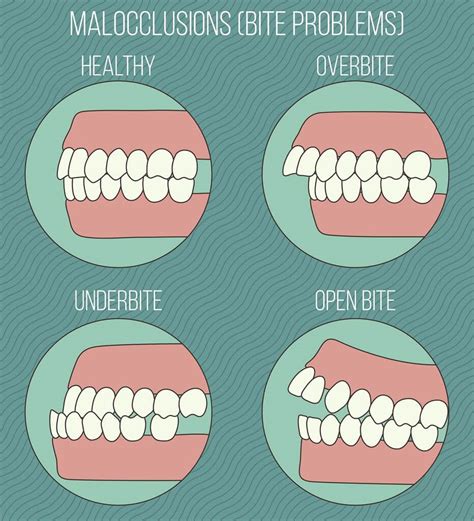 How to Treat Open Bite | Orthodontics in London