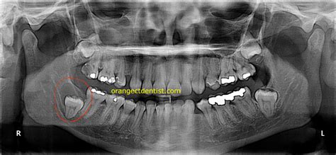 Dentigerous Cyst | Calcaterra Family Dentistry | Follicular Cyst