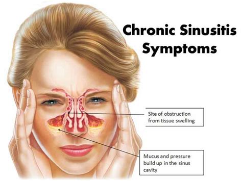 Chronic Sinusitis Symptoms and Treatments - Sggreek.com