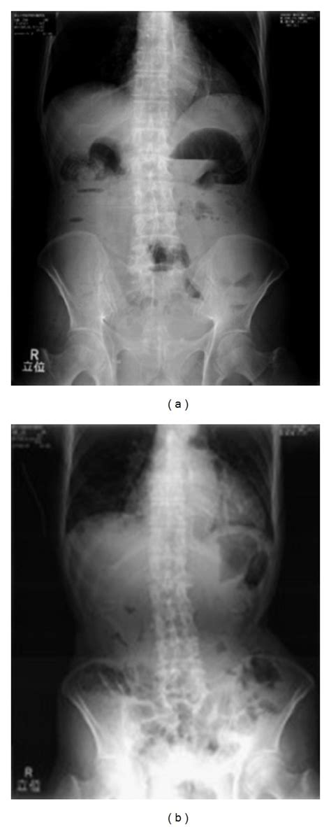 Abdominal X-ray radiographs of a 95-year-old paralytic ileus patient ...