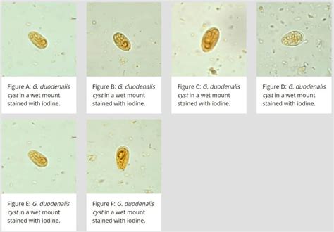 Giardia duodenalis (Giardia lamblia or Giardia intestinalis)