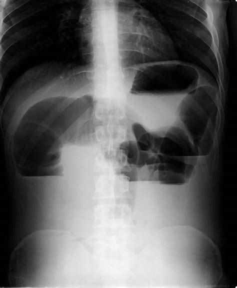 [DIAGRAM] Diagram Of Bowel - MYDIAGRAM.ONLINE