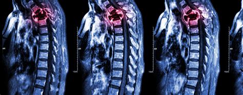 Lung Cancer Metastases to Bone: Overview and More