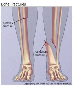 Fracture Rehabilitation - Urgent Care Physiotherapy Clinic ...