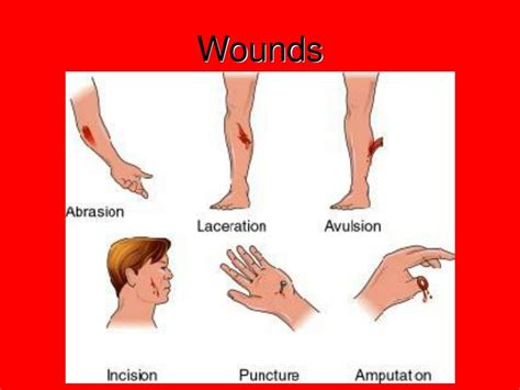 Wound Location Chart