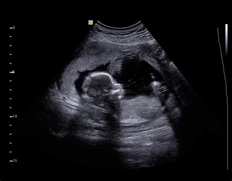 First Look at Your Baby: The Fascinating History of the "Sonogram"