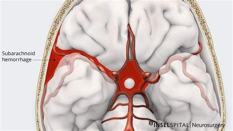 Subarachnoid Hemorrhage Vs Intracerebral Hemorrhage