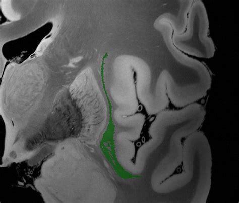 Research about the Claustrum - Visual Neuroscience