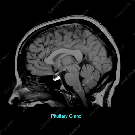 Pituitary Gland, Sagittal MRI - Stock Image - C030/6315 - Science Photo ...