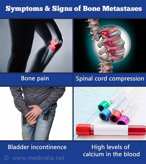 Bone Metastases | Osseous Metastatic Disease - Causes, Symptoms ...