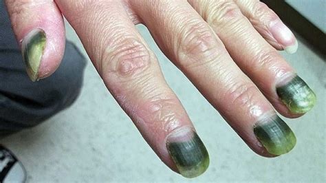 A case of green nail syndrome - MyDr.com.au