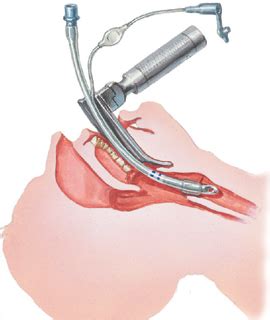 Intubation - Intensive Care Hotline