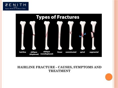 Hairline Fracture - Causes, Symptoms and Treatment by zenithdfw - Issuu