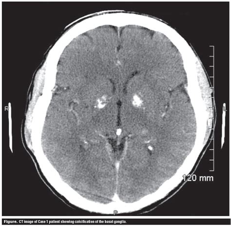 Basal ganglia calcification in idiopathic hypoparathyroidism | British ...