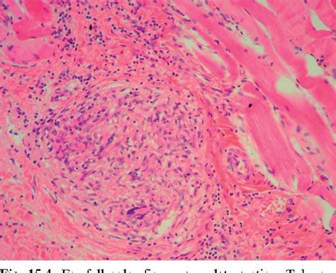 viral myositis | Semantic Scholar