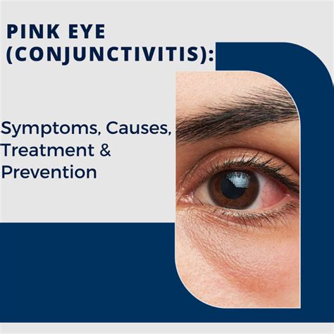 Pink Eye (Conjunctivitis): Symptoms, Causes, Treatment, & Prevention ...