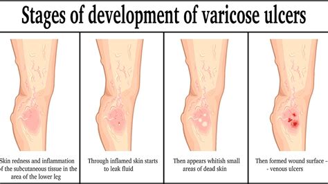 Venous Stasis Leg Ulcer - Ulcer Choices