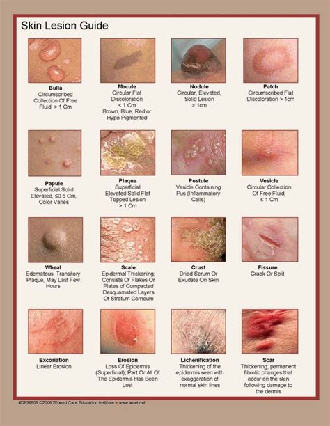 53 best images about Dermatology on Pinterest | Sebaceous cyst, Foot ...