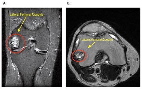 JCM | Free Full-Text | Intraosseous Bioplasty for a Subchondral Cyst in ...