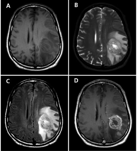 Brain Mri Tumor