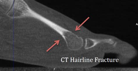 Hairline Fractures: Dx w/ In-Office CT Imaging - CurveBeam AI