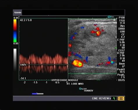 Ultrasound and Color Doppler videos: Multinodular goiter thyroid- Color ...