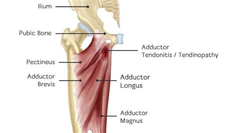 torn inner thigh muscle > OFF-71%