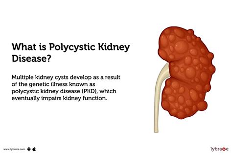 Polycystic Kidney Disease: Treatment, Procedure, Cost, Recovery, Side ...