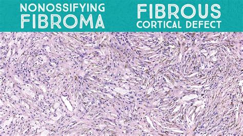 Non-ossifying fibroma (metaphyseal fibrous defect/fibrous cortical ...