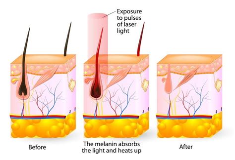 How Does Laser Hair Removal Work? About Hair Removal | LivSmooth