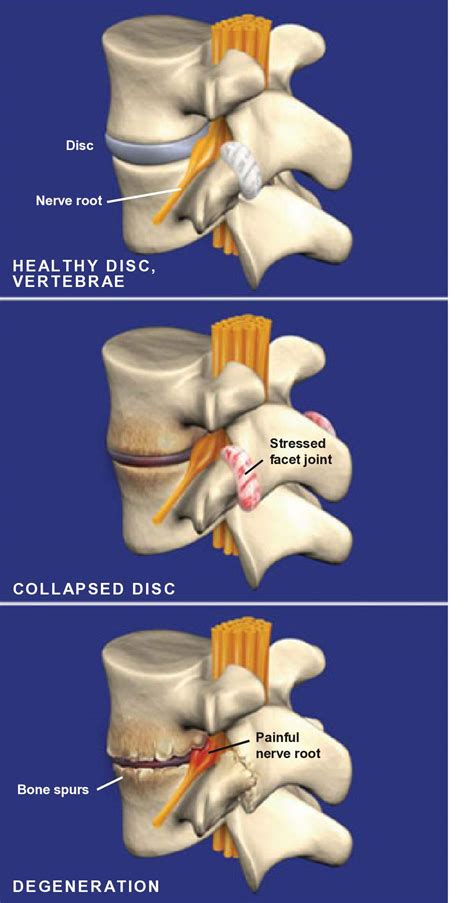 Types Of Spondylosis