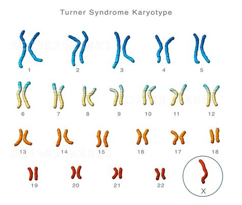 Turner's Syndrome Karyotype | Stock Image - Science Source Images