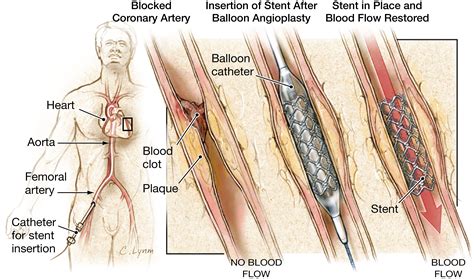 Stents to Treat Coronary Artery Blockages | Cardiology | JAMA | The ...