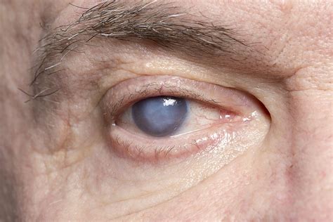 Cataract Symptoms - Monterey, CA - Monterey County Eye Associates