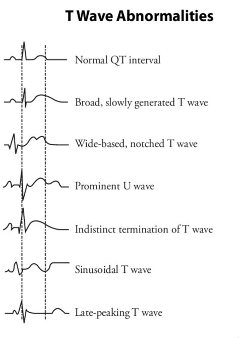 T wave abnormalities | Human anatomy and physiology, Normal ecg, Pr ...