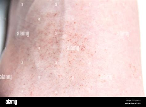 A red rash on the foot of a male against background. CloseUp a part of ...