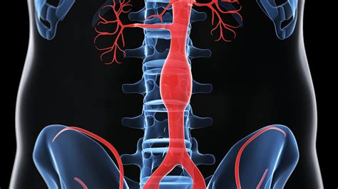 What to know about ascending aortic aneurysm after Grant Wahl's sudden ...