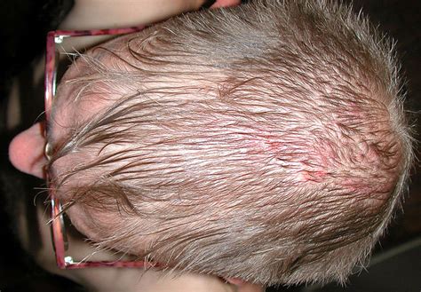 Itchy Scalp - Symptoms, Pictures, Causes, Treatment, Remedies, Dry ...