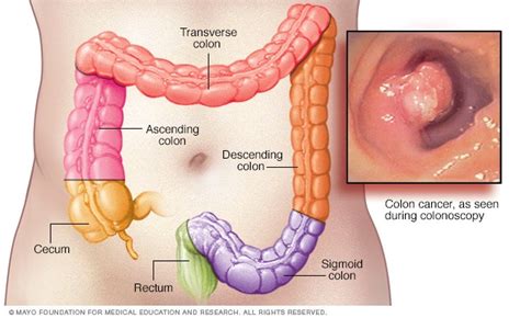 Cáncer de colon - Síntomas y causas - Mayo Clinic