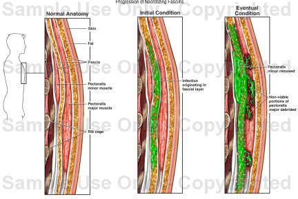 Necrotizing Fasciitis - Causes, Symptoms, Pictures, Statistics and ...