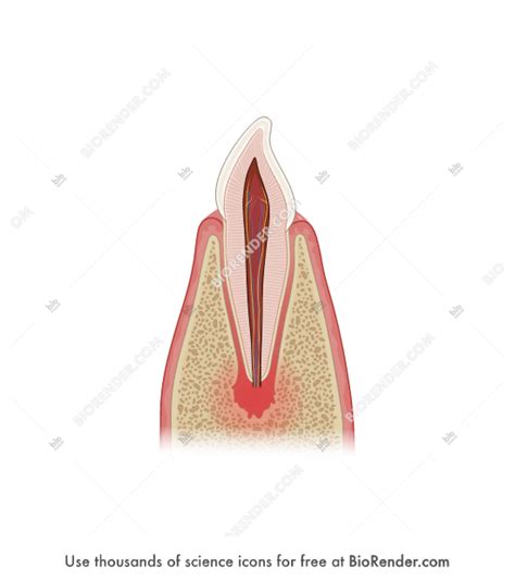 Free Apical periodontitis (primary incisor) Icons, Symbols & Images ...