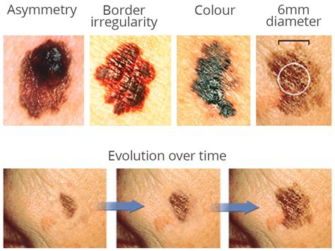 Toowong | Skin Cancer Early Diagnosis