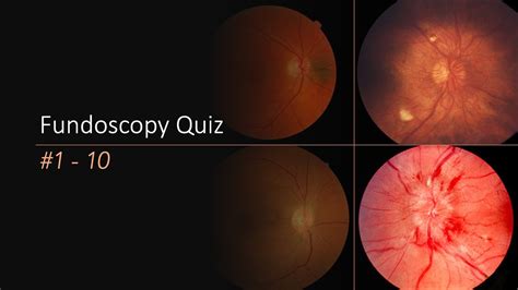 Fundoscopy Quiz - YouTube