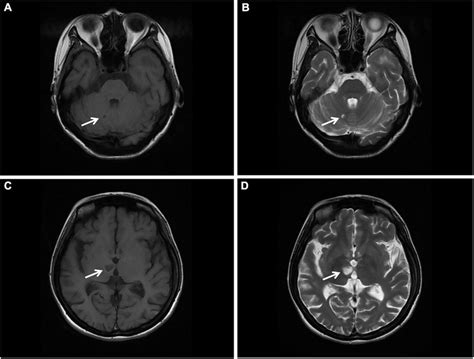 Brain MRI. (A,B) T1 and T2 sequences showing cerebral infarction with a ...