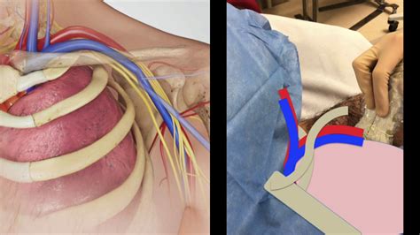 Ultrasound Guided Subclavian Vein Cannulation How I Do It – Otosection