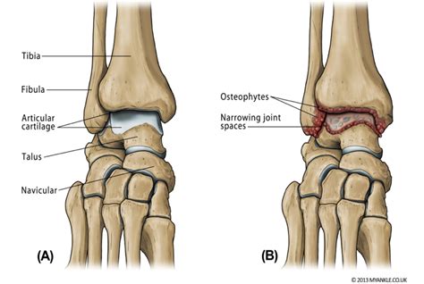 What Is Ankle Arthritis? - MyAnkle | Ankle Arthritis Surgeon London