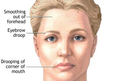 Myasthenia Gravis: Causes, Symptoms, Diagnosis, and Treatment