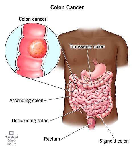 Understanding Colorectal Cancer - Ask The Nurse Expert