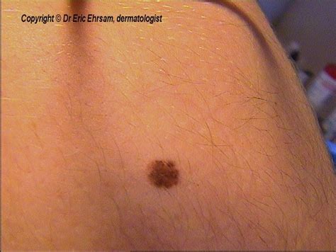 dermoscopy: Melanoma in situ